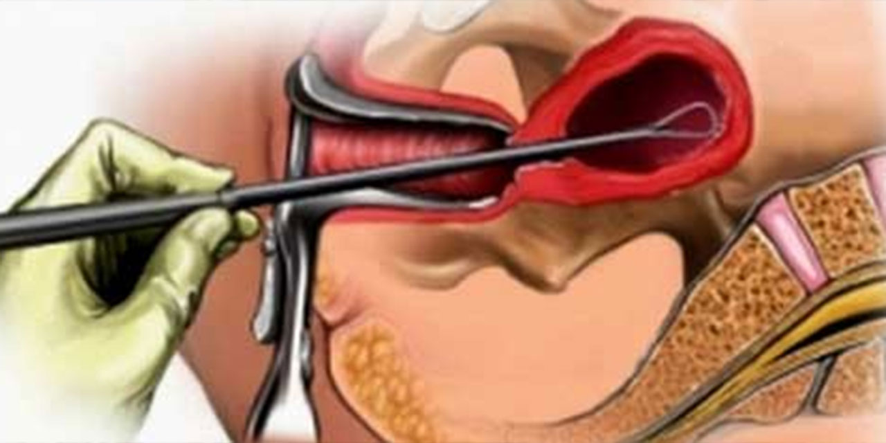Раздельное диагностическое выскабливание полости матки. Хирургический аборт выскабливание. Выскабливание полости матки инструментарий диагностическое. Гистероскопия с биопсией эндометрия. Выскабливание цервикального канала шейки.